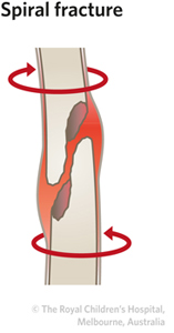 Section 2A.Spiral fracture